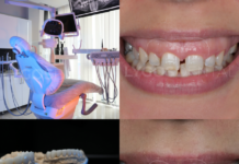 Why Istanbul Has Become the Preferred Destination for Smile Makeovers ?