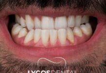 Emax vs Zirconia: Which Dental Veneer is Better for Your Smile?