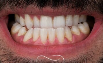 Emax vs Zirconia: Which Dental Veneer is Better for Your Smile?