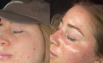 Colorado Springs Med Spa Addresses Growing Demand for Adult Acne Treatment Programs
