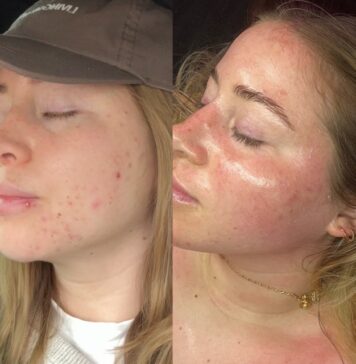 Colorado Springs Med Spa Addresses Growing Demand for Adult Acne Treatment Programs